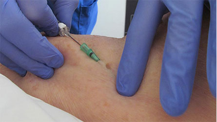 Peripheral Intravenous Cannulation